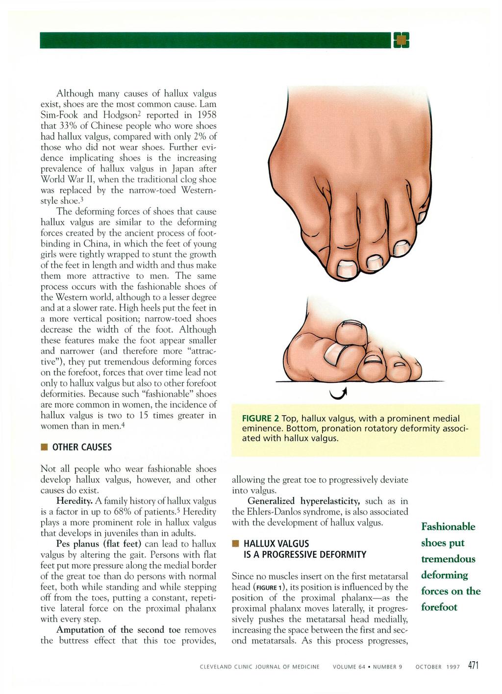 Although many causes of hallux valgus exist, shoes are the most common cause.