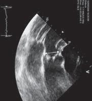 it was noted that the distance between the aortic annulus and the coronary ostia was smaller than the length of the AV leaflets in up to 49% of the patients (31).