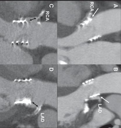 recognition of complications during percutaneous AV implantation.