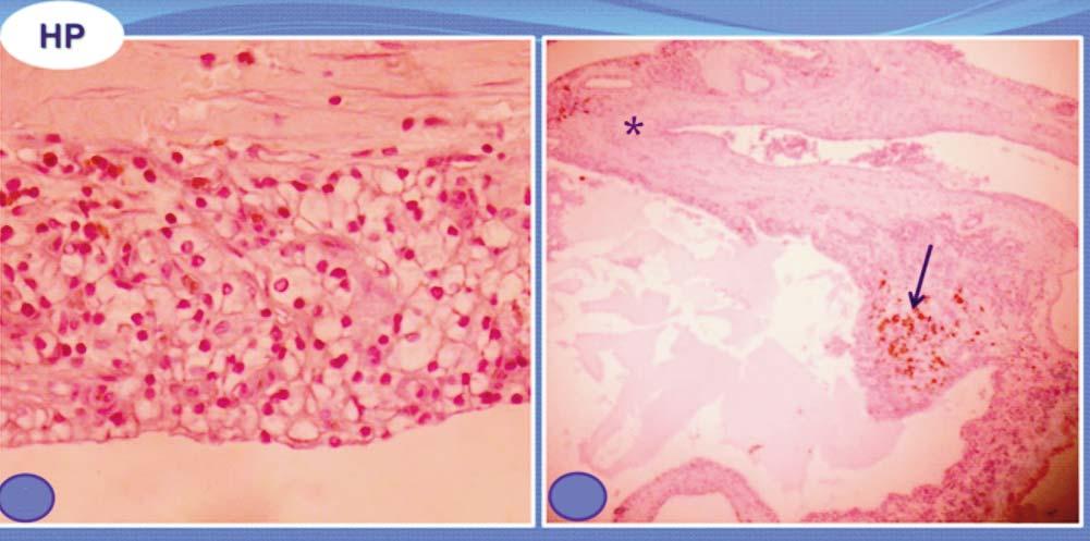 Emi Mrinel Pred et l Figure 3 - Photomicrogrph of histologic section (H nd E, 200) shows: () typicl histologic ppernce of cler cell renl cell crcinom, showing epithelil cells with cler cytoplsm nd