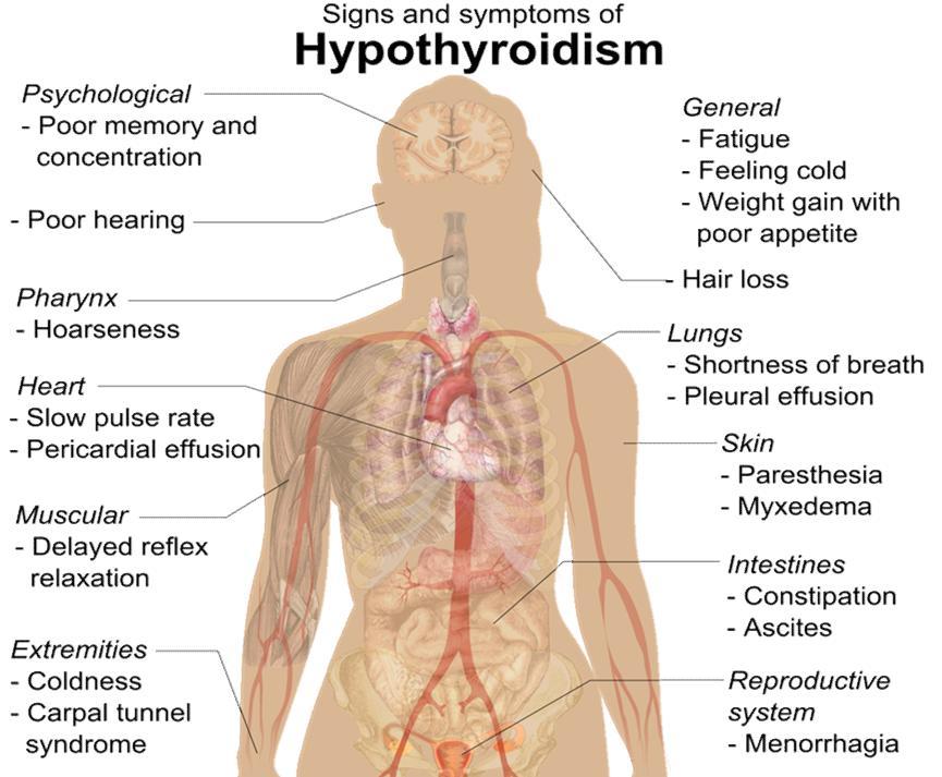 Hypothyroidism: Is the underproduction of the thyroid hormones T 3 and T 4. Hypothyroid disorders may occur as a result of: Congenital thyroid abnormalities (Thyroid deficiency at birth).