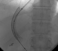 Blockade Esophageal Varices: Banding QuickTime and a H.263 decompressor are needed to see this picture.