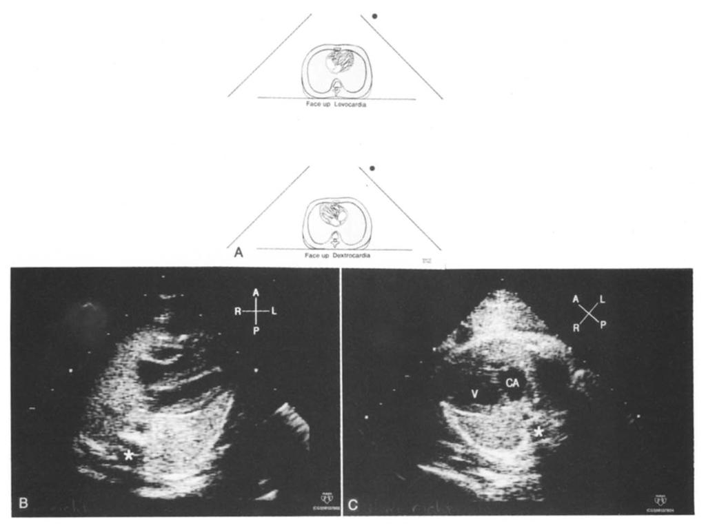 Image (C) demonstrates dextrocardia in fetus with complex congenital heart disease, lying face up. CA, Common atrium; V, ventricle; *spine.