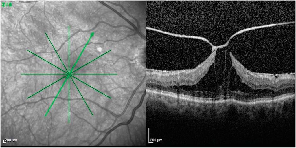 910 RETINA, THE JOURNAL OF RETINAL AND VITREOUS DISEASES 2018 VOLUME 38 NUMBER 5 Fig. 3. Correlation between the preoperative central foveal thickness and postoperative best-corrected visual acuity.