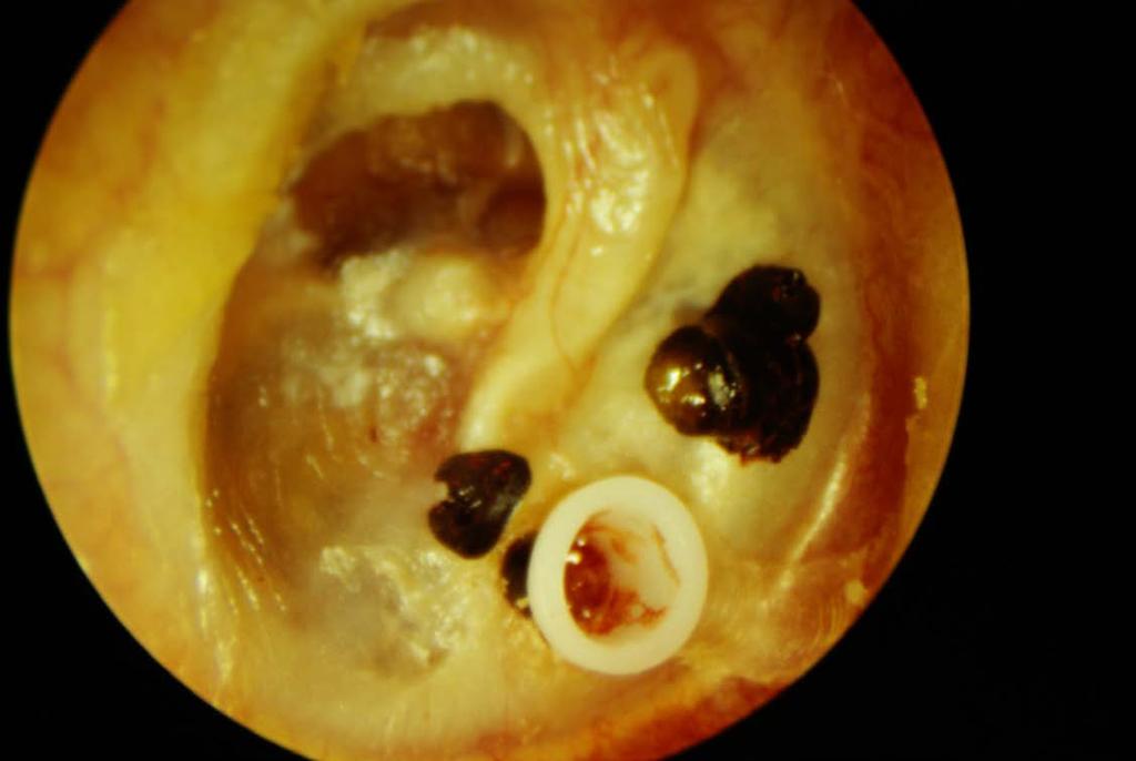 Occlusion of a 1.14 mm Collar Bobbin in a chronic effusion case.