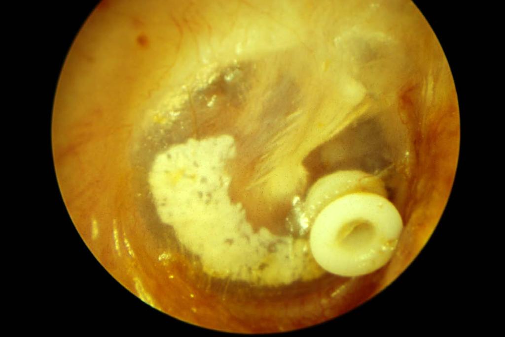 Pars tensa tympanosclerosis, subsequent to a Collar Button tube