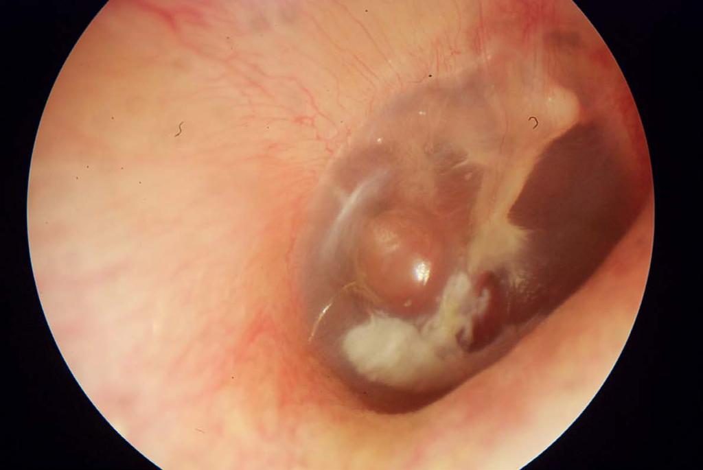 A dimpled posterior pars tensa resulting from a Shepard tube insertion in the