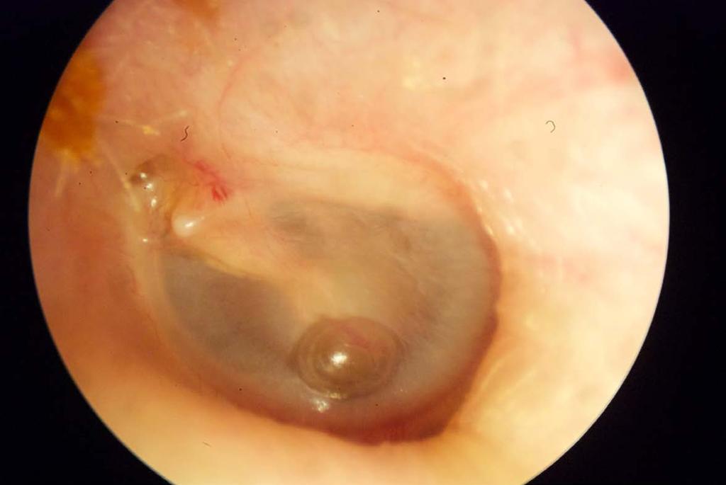 An inferior dimple in the pars tensa following extrusion of a Collar Button tube.