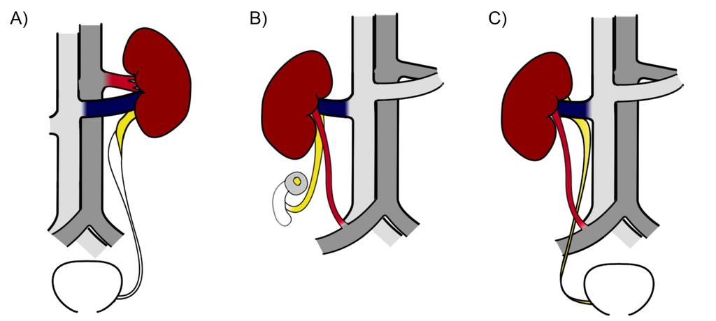 Figures and Tables Fig. 1. Diagrams for orthotopic kidney transplants (OKT) performed in current series.
