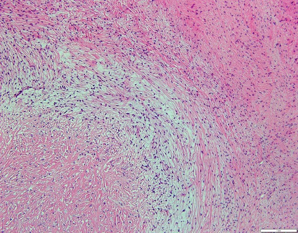 GROSS EXAMINATION: A 7.4 x 5.6 x 5.4 cm gray-tan to white, granular, nodular mass was identified within the mesentery of the segment of small bowel.