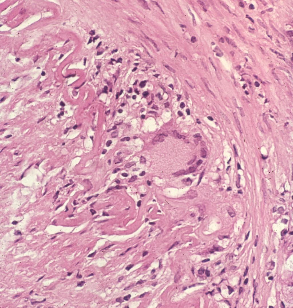 biopsy Diagnose TA Reveal extent of vasculitic