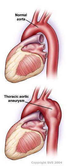 Thoracic aortic aneurysm Aortic aneurysm 1995 study from Minnesota TA patients 17x more likely to develop thoracic aortic aneurysms 5-10 years after TA TA patients 2.