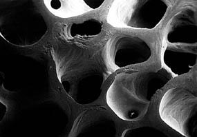 Scanning electron microscopy of normal and osteoporotic bone Burden