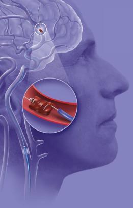 Endovascular Thrombectomy of Cerebral Vessels Merci Retriever First surgical device cleared by the FDA for acute ischemic stroke patients in