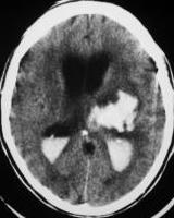 CT role: evaluation of acute stroke Exclude hemorrhage and stroke mimics Hemorrhage, tumor, etc.