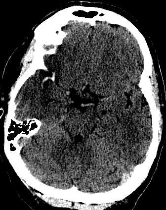 Infarct detection with CT: Hyperdense artery sign Densest vessel visualized Early signs Loss of gray/white differentiation Subtle but usually positive within 1-3 hours Cortical band or insular ribbon