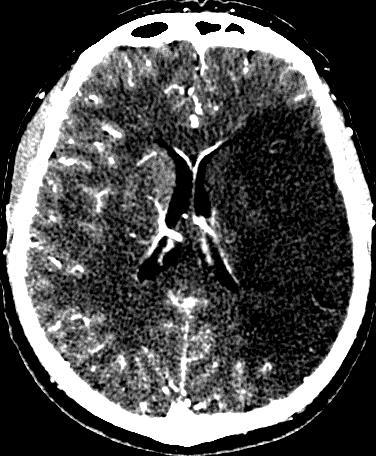 CTA source images for acute infarction NCCT and CTA source images compared (51 pts) Follow-up imaging to confirm infarct volume Results: 33 patients had an infarct NCCT sensitivity: 48% CTA source