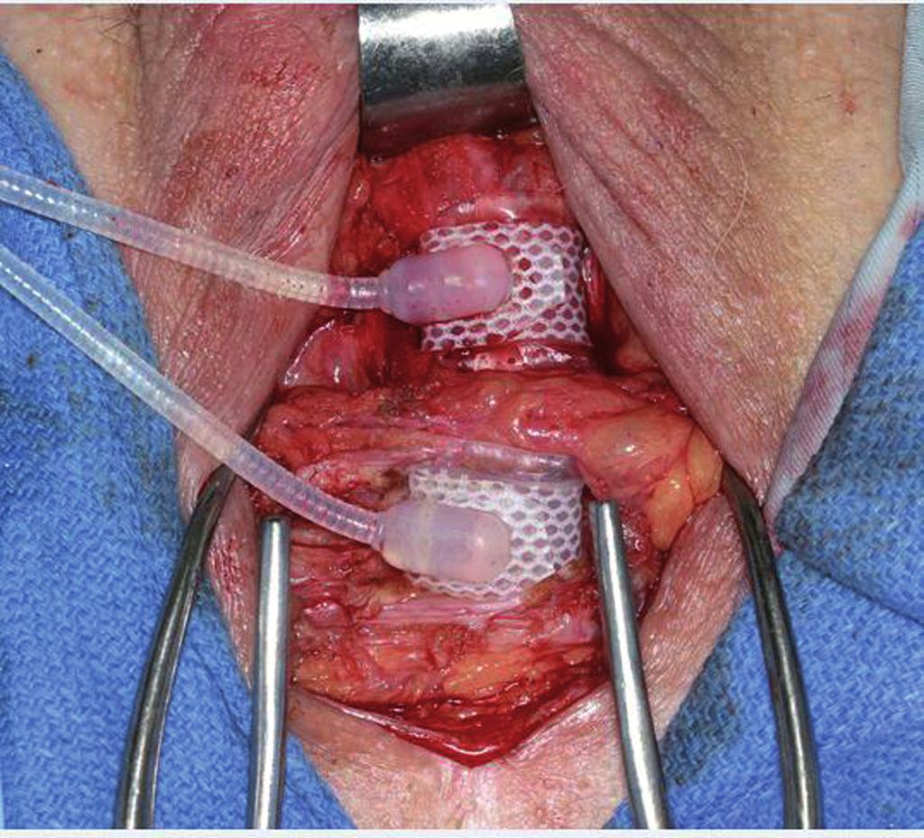 ibju Management of urethral atrophy following Artificial Urinary Sphincter placement Unfortunately, there is a paucity of data comparing these management strategies, and those currently available are