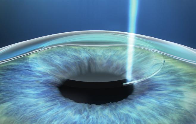 refractive lenticule and a small incision of less