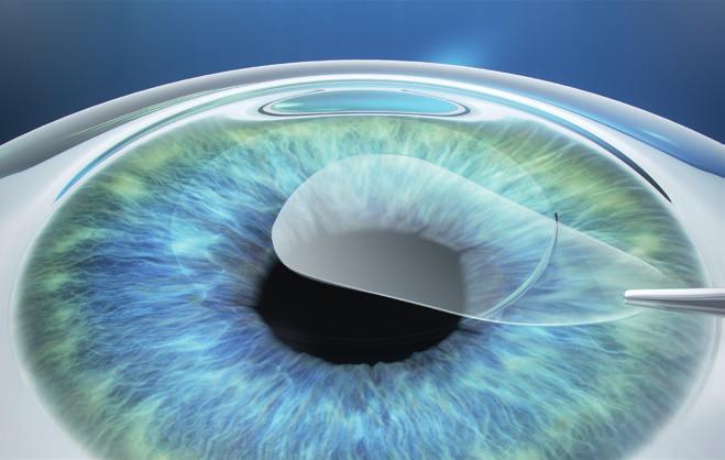 The disruption to the corneal biomechanics is minimal.