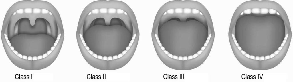 Fig. 1. Modified Mallampati classification (the relative position of the palate and base of tongue inside the mouth).