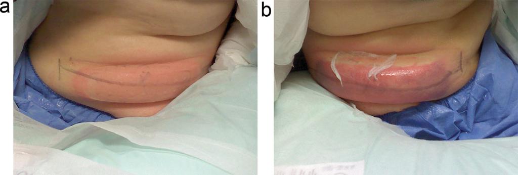 PROTOTYPE COOLCUP CRYOLIPOLYSIS APPLICATOR 65 Fig. 3. Comparison of immediate post-treatment photographs showing firm butter stick treatment areas from both applicators.