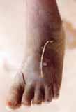 Guinea-worm disease Dracunculiasis is transmitted exclusively by drinking contaminated water.