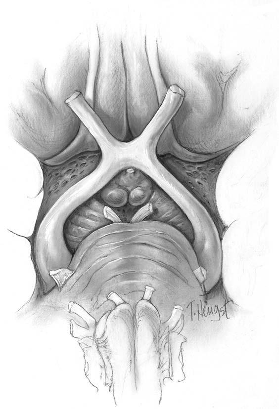 36 CLINICAL NEURO-OPHTHALMOLOGY Figure 1.38. The optic chiasm viewed from below. Note relationships of the mammillary bodies, oculomotor nerves (III nerve), and cerebral peduncles to the chiasm.
