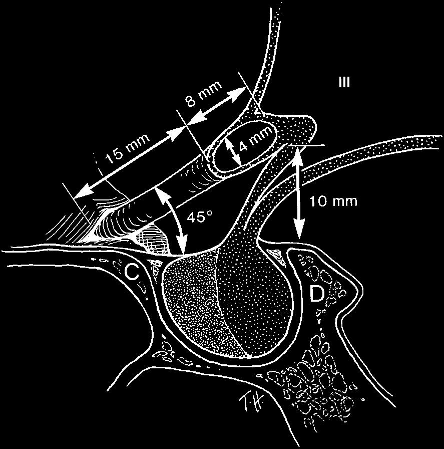 St Louis, CV Mosby, 1977 75 105.) Figure 1.42. MRIs of the normal optic chiasm. A, Noncontrast T1-weighted image shows position of the optic chiasm in sagittal section.