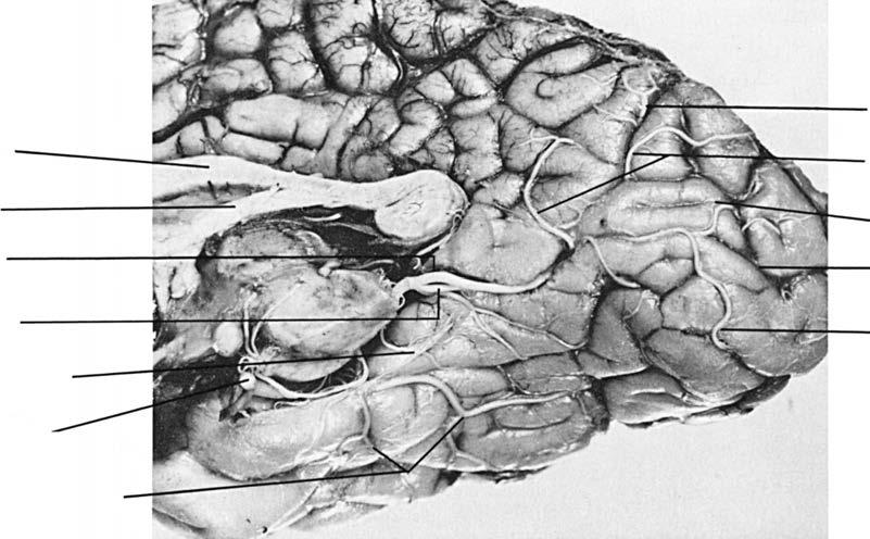 62 CLINICAL NEURO-OPHTHALMOLOGY Figure 1.71. The posterior cerebral artery and its branches that supply the striate cortex. (From Lindenberg R, Walsh FB, Sacks JG. Neuropathology of Vision.
