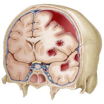 location of bleeding Major Types: epidural, subdural, subarachnoid, intraparenchymal, intraventricular HEMORRHAGIC STROKE Intracerebral hemorrhage Sudden onset focal neurologic