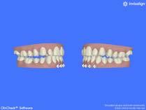 not same patient) Removable Expander 92 Treatment Plan: Achieve Maxillary Expansion First.