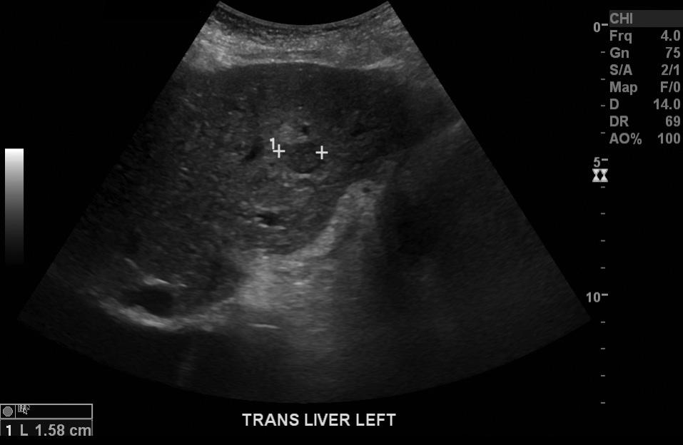 Materials and Methods Three patients with a known history of cirrhosis or other chronic liver disease underwent abdominal sonography.