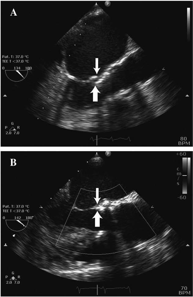 Implant Depth Impacts Conduction Disturbances A lower (ventricular) position of the valve relative to the hinge point of the anterior mitral leaflet was associated with a higher incidence of new