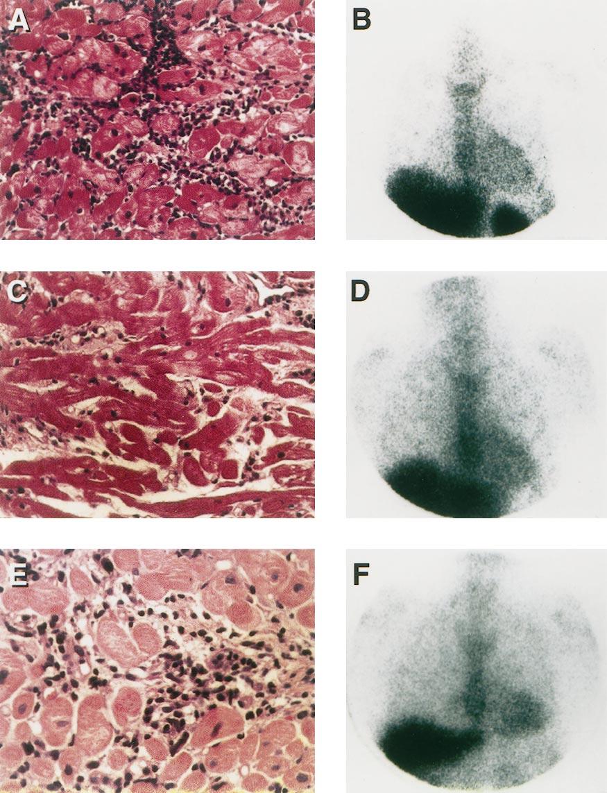 1360 BALLESTER ET AL. JACC Vol. 31, No. 6 BIOPSY CLASSIFICATION OF HEART TRANSPLANTATION REJECTION Antimyosin scintigraphy allows sensitive identification of myocardial necrosis.