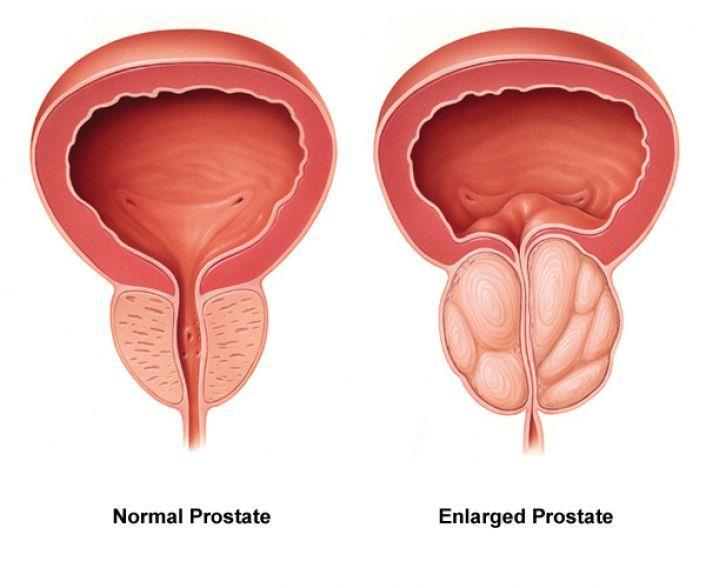 BPH Benign Prostatic Hypertrophy Enlarged prostate Prostate enlarges and grows - puts pressure on bladder which limits flow of urine to the urethra Symptoms: Frequent urination, especially at night,