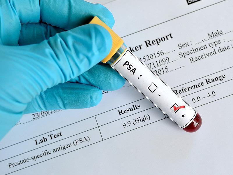 Prostate Tests Digital rectal exam Urine test can be used to rule out an infection or other conditions that have similar symptoms Blood test can be used to check for kidney problems.