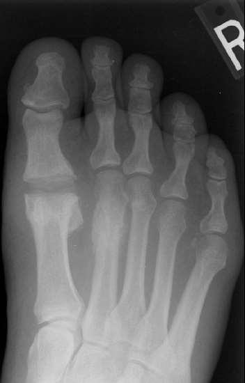 Complications Infection Lack of hallux purchase Painful/limited ROM Fracture of metatarsal &/or phalanx