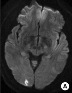 Migrainous Infarcts Classical Migraine vascular risk factor Migrainous infarction: Infarct during attack where aura lasts > 60