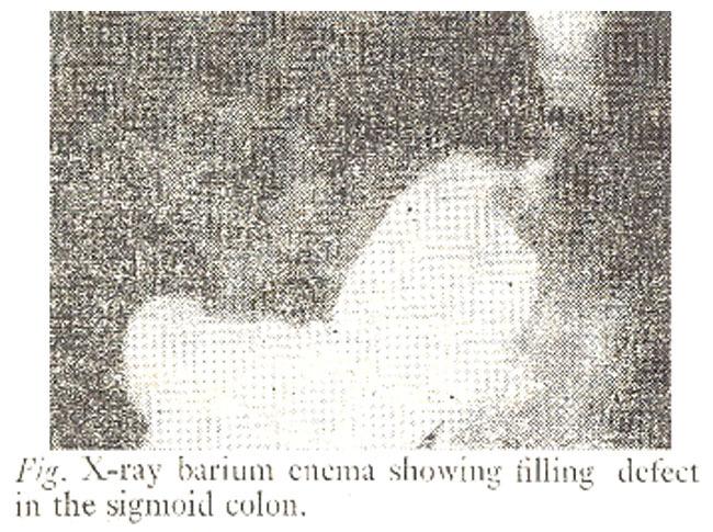 Sigmoidoscopy revealed a further tumour at 13 cms which was not suspected on the barium enema. On 10-5-1979 abdomino perineal excision of the rectum and the distal colon was performed.