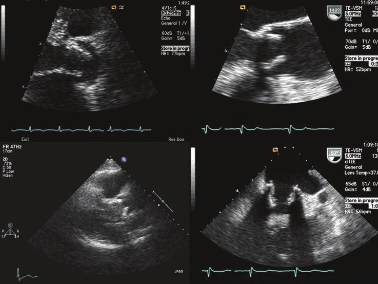 BIOPROSTHETIC BENT STRUT ARTIFACT Figure 1. Clinical echocardiographic images revealing apparent inward deflection (from sewing cuff to commissural posts) of various bioprostheses. A. Mosaic (Medtronic, Inc.