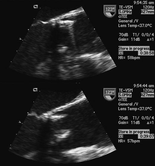 BIOPROSTHETIC BENT STRUT ARTIFACT Figure 6. Beat-to-beat variability of apparent strut orientation on clinical transesophageal echocardiogram of porcine bioprosthesis in aortic position.