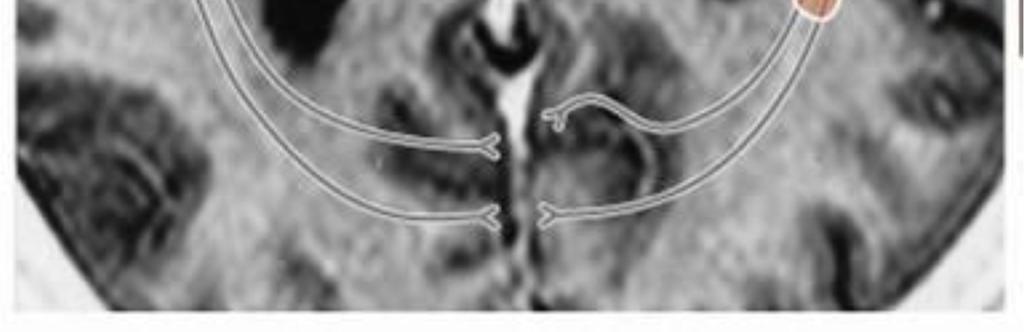 cortex) in cerebral cortex also in the 4th layer, also it will travel to association areas ( Broadman area#18) in superior part of occipital lobe and