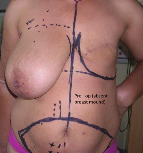 The three stages of breast reconstruction BY FORTUNE C IWUAGWU Breast cancer has become so common that most people reading this article will know someone (either professionally or personally) who has
