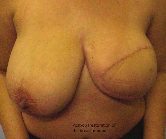 The objective or the aim of breast reconstruction is to help restore the patient s quality of life.