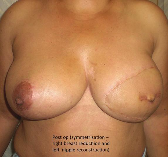autologous tissues and nonautologous materials include: There is a provision of adequate amount of tissue to match the volume of the contralateral breast.