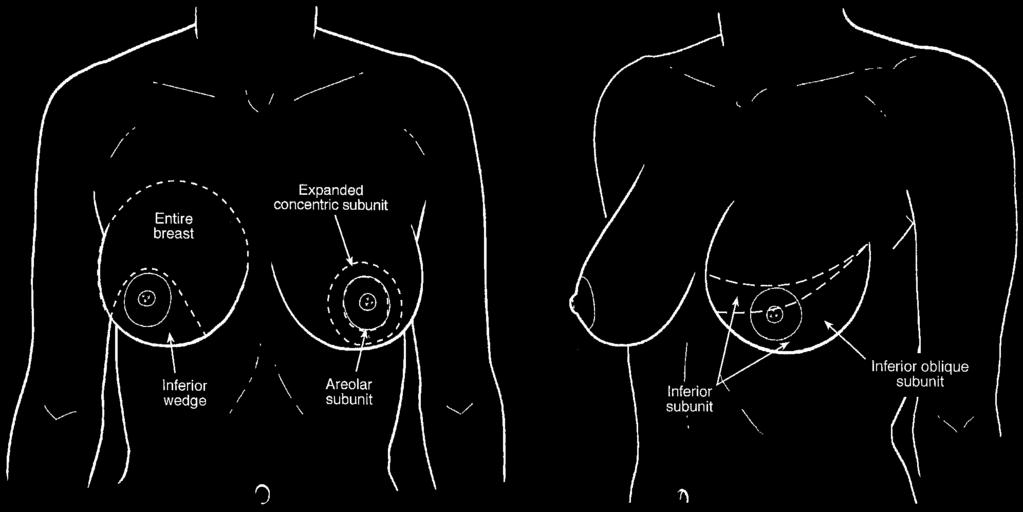 442 PLASTIC AND RECONSTRUCTIVE SURGERY, August 2003 FIG. 2. Drawing of aesthetic subunits on the breast that represent favorable use of the transition lines.