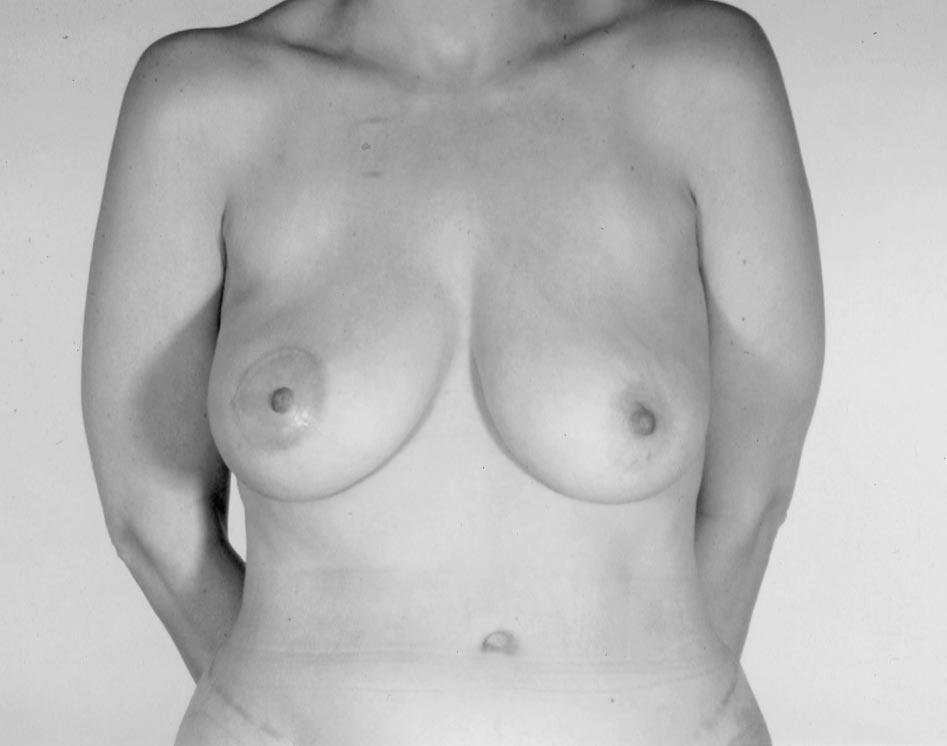 The right breast is reconstructed with a unilateral pedicle TRAM flap. areola, and a large concentric circular subunit is also acceptable (Fig. 4).