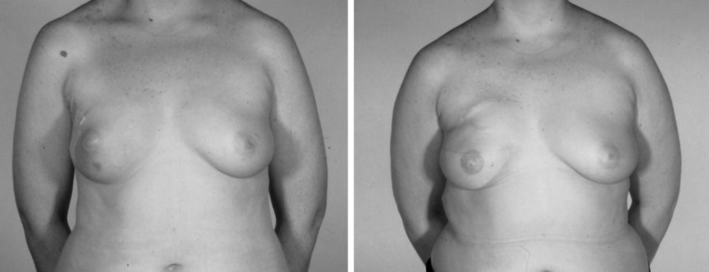 444 PLASTIC AND RECONSTRUCTIVE SURGERY, August 2003 FIG. 5. An aesthetic subunit is the inferior pole of the breast and lateral inferior cup with the watermark at the oblique nipple plane.