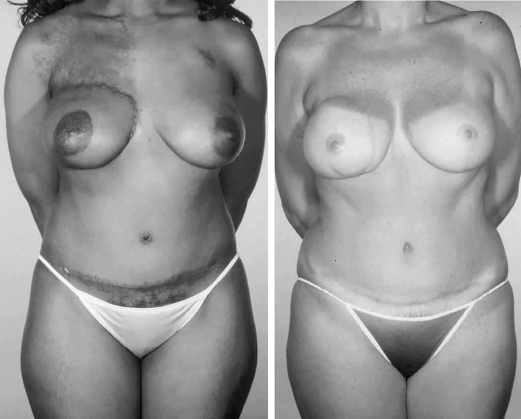 Vol. 112, No. 2 / AESTHETIC SUBUNITS OF THE BREAST 445 FIG. 8. Examples of TRAM flap replacement of an entire breast subunit.